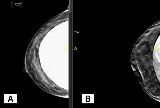 Standard craniocaudal implant included view of the right breast