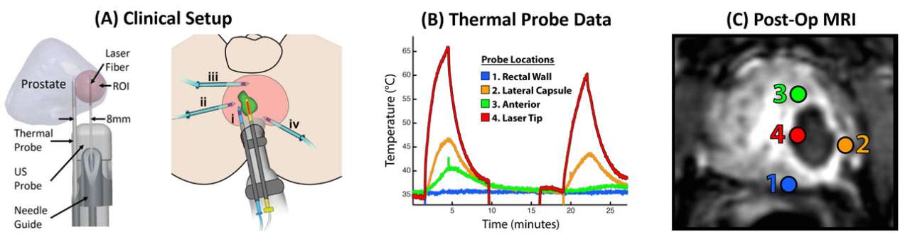 Focal Laser Ablation