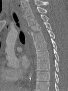 X-ray of Jim's spine with sixteen titanium screws and two rods