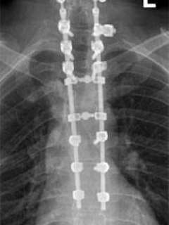 X-ray of Jim's spine with two rods clearly visible