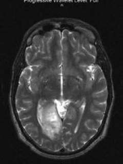 Preoperative functional MRI T2 axial view of Robert's brain