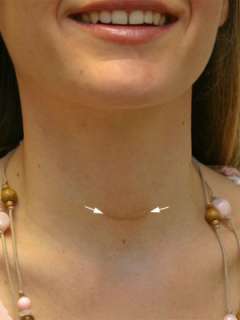 Scar after benign thyroid disease surgery