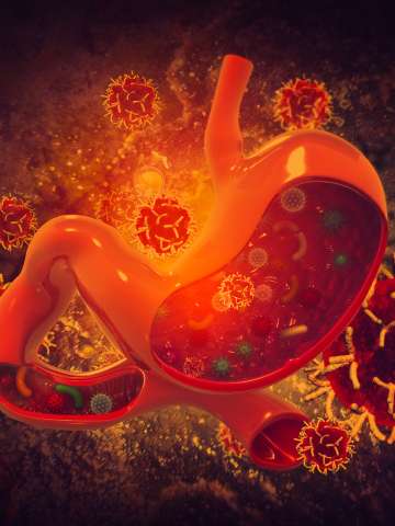 Stomach cancer Illustration