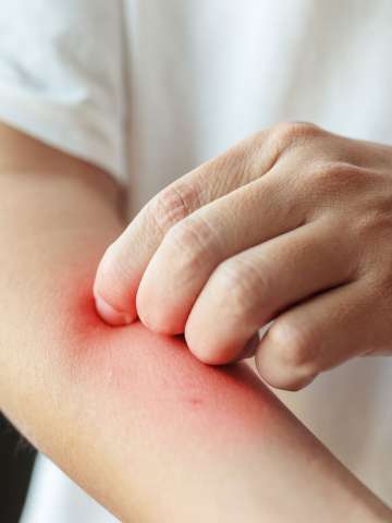 Itching, scratching on arm from insect bite or itchy dry skin eczema dermatitis