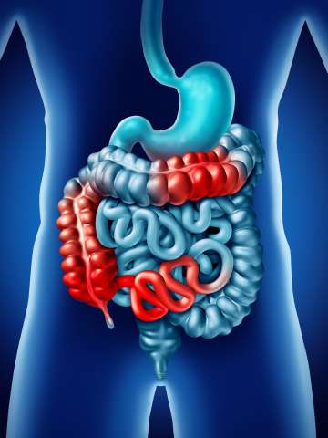 Inflammatory Bowel Diseases (IBD)
