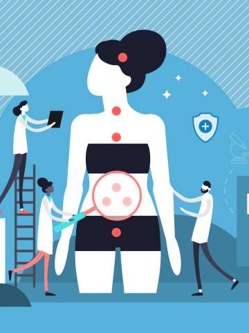 Irritable bowel syndrome (IBS) Illustration