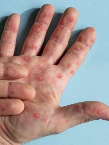 Monkeypox on hands