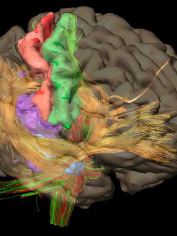 brain tumor