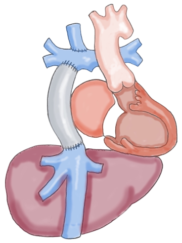 Heart and Liver Disease - Fontan Physiology