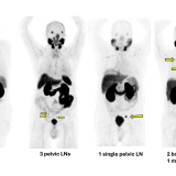 figure of PSMA PET scans
