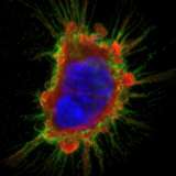 A bone cancer cell.
