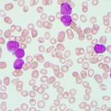 B-lymphoblastic leukemia cells