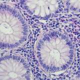 Microscopic image of colon cancer cells