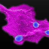Microscopy image showing blood stem cell-engineered CAR-NKT cells (blue) attacking a human solid tumor cell (magenta)