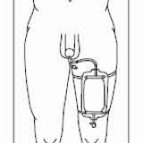 catheter