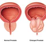 Normal vs. enlarged prostate