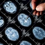 brain tumors