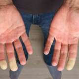 Raynaud's phenomenon