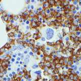 IGF2BP3 IHC performed on a B-ALL case; the blasts are positive and the normal hematopoietic cells are negative.