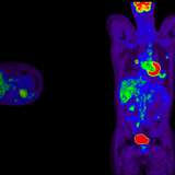 PET/CT scan for nuclear medicine