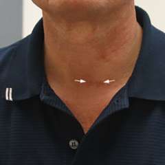 MIP Scar After Surgery